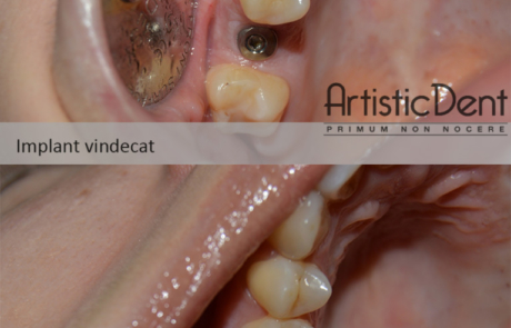 Implantvindecaty-768x1024