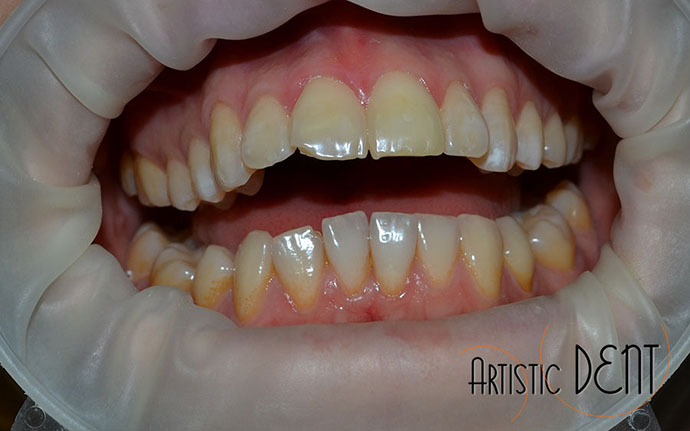 albire-dinte-fara-nerv-nr1