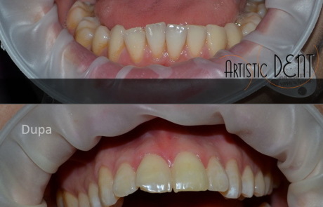 albire-dinte-fara-nerv-nr2