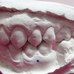 aparat-dentar-incognito2-150x150