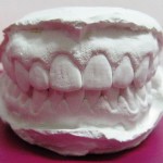aparat-dentar-invizibil-150x150
