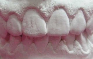 aparat-dentar-invizibil-870x350