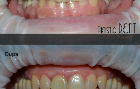 coroana-integral-ceramica-1