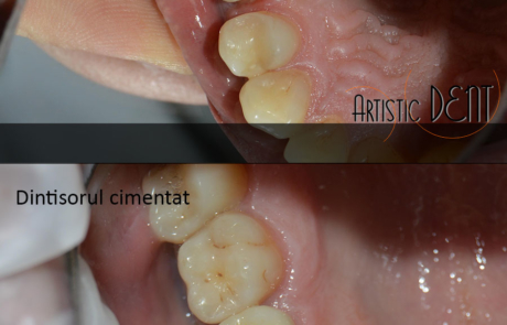 coroana-integral-ceramica-3