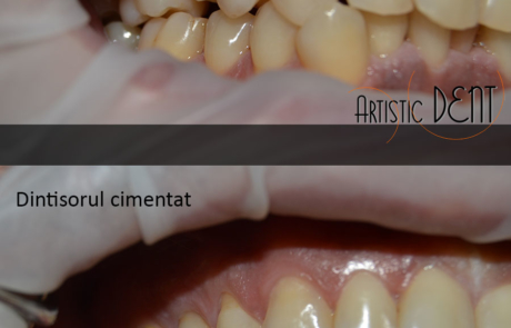 coroana-integral-ceramica-4
