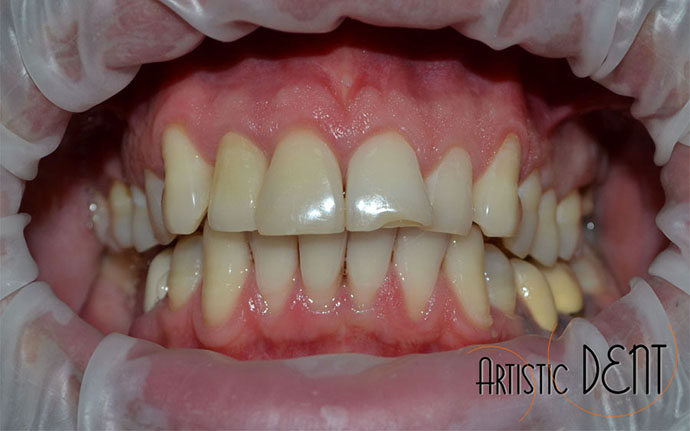 coroana-integral-ceramica-nr1