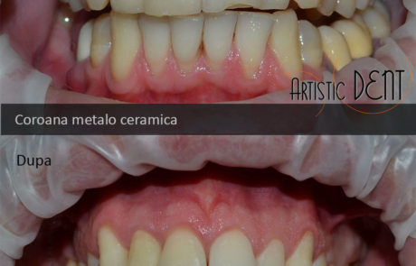 coroana-integral-ceramica-nr2