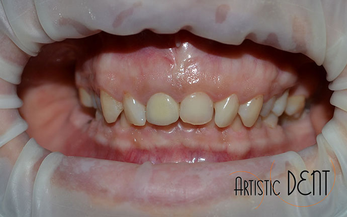 coroana-metalo-ceramica-nr1