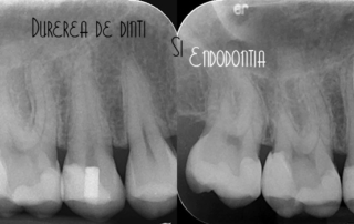 endo-articol-cover-copy