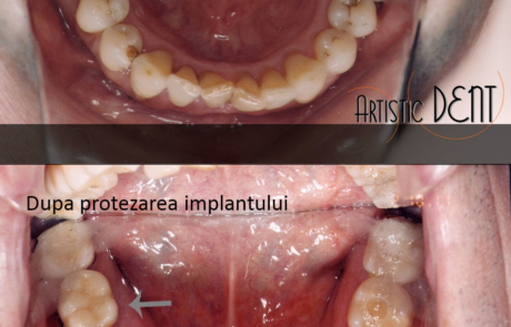 implant-dentar-straumann-1