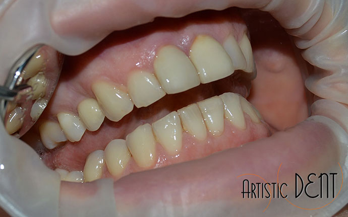 implant-dentar-straumann-nr1