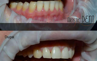 obturatie-dinte-frontal-1