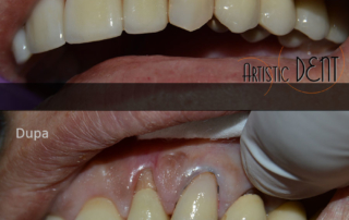 obturatie-dinte-frontal-10