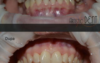 obturatie-dinte-frontal-11