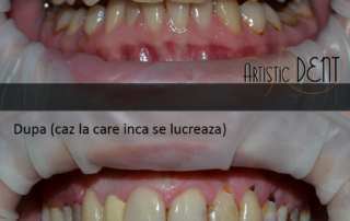 obturatie-dinte-frontal-12