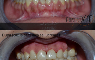 obturatie-dinte-frontal-13