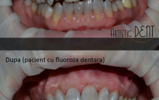 obturatie-dinte-frontal-14