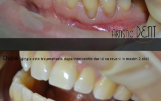 obturatie-dinte-frontal-15