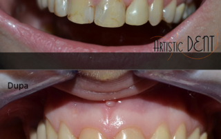 obturatie-dinte-frontal-16