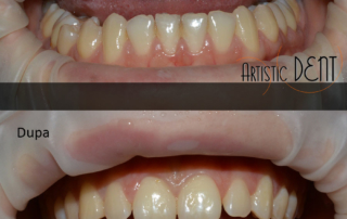 obturatie-dinte-frontal-17