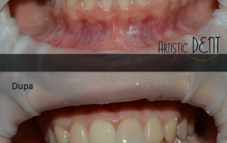 obturatie-dinte-frontal-18