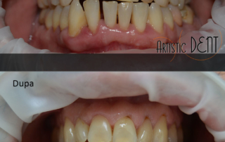 obturatie-dinte-frontal-19