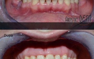 obturatie-dinte-frontal-2