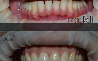 obturatie-dinte-frontal-3