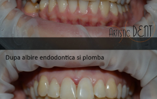obturatie-dinte-frontal-4