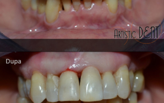 obturatie-dinte-frontal-5