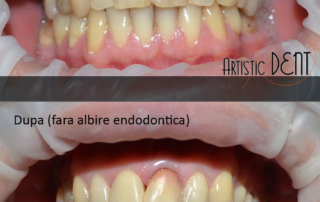 obturatie-dinte-frontal-6