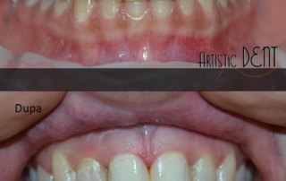 obturatie-dinte-frontal-7