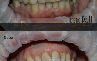 obturatie-dinte-frontal-8