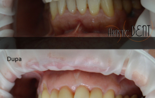 obturatie-dinte-frontal-9